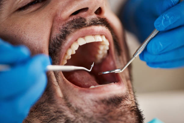 Best Emergency Tooth Extraction in Waxhaw, NC